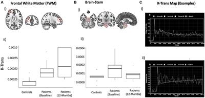 Blood brain barrier disruption and glutamatergic excitotoxicity in post-acute sequelae of SARS COV-2 infection cognitive impairment: potential biomarkers and a window into pathogenesis